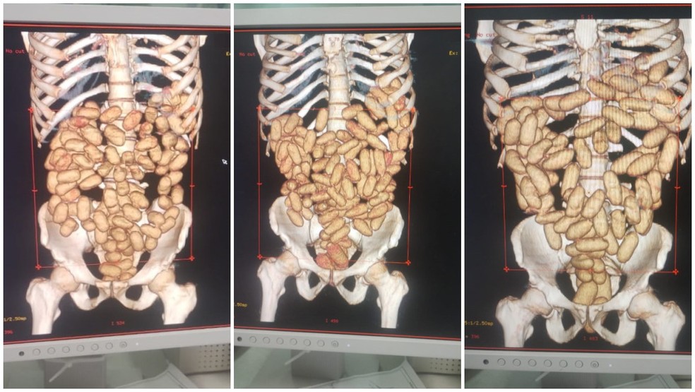 Exames de raio-x mostram cápsulas com cocaína dentro dos estômagos de estrangeiros — Foto: Divulgação